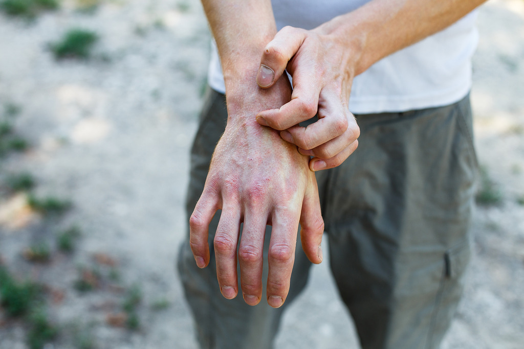 What Are the Early Warning Signs of Psoriatic Arthritis (PsA)? | RMG