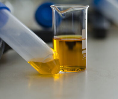 Closeup of a Vial & Beaker Filled With Dark Yellow Urine What Does the Color of Your Urine Mean